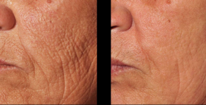 3D Skin Rejuvenation before and after