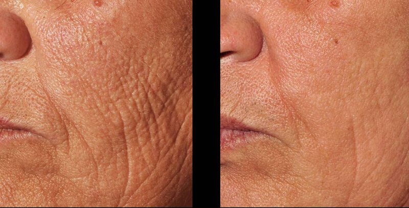 3D Skin Rejuvenation before and after