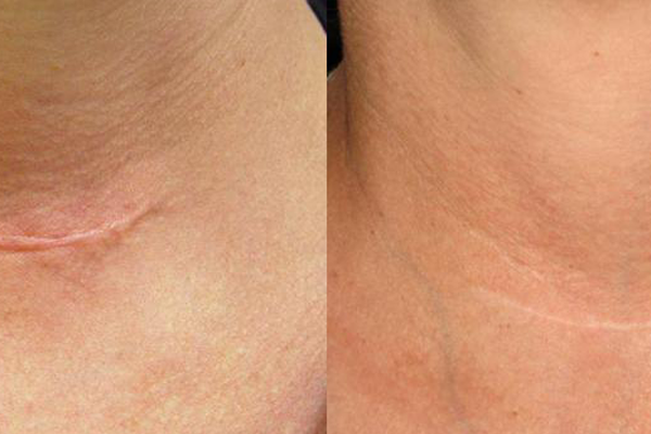 Scar Therapy Vancouver