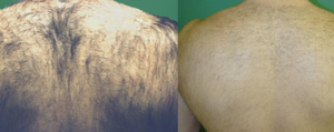 Hair Removal Results