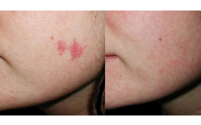 Face Vein Removal