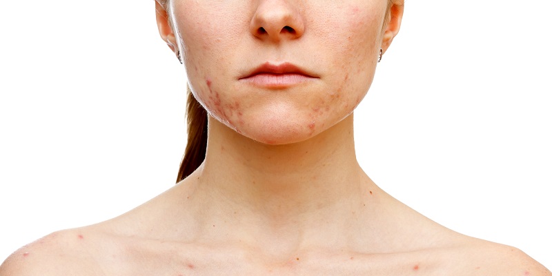 pcos acne treatment solution