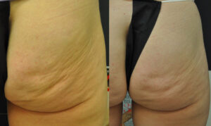 cellulite removal vancouver