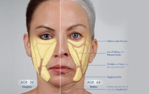 facial fat loss treatment